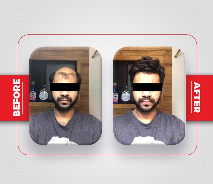 Hair Patch Service Before After