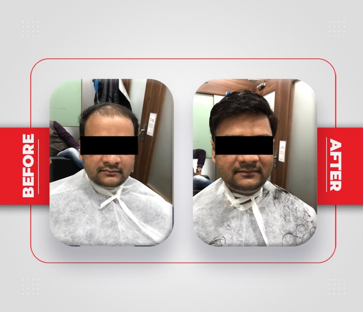 Hair Patch Service Before After