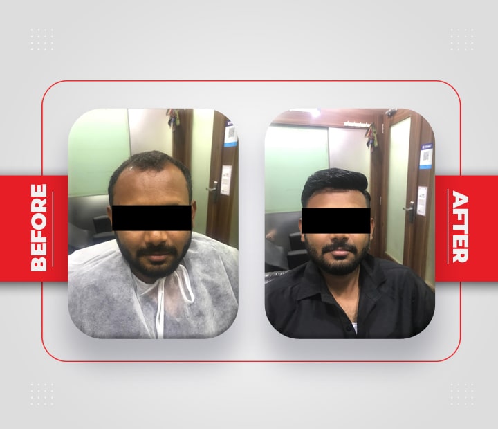 Hair Patch Service Before After