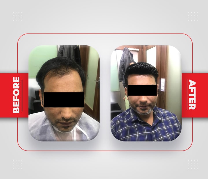 Hair Patch Service Before After