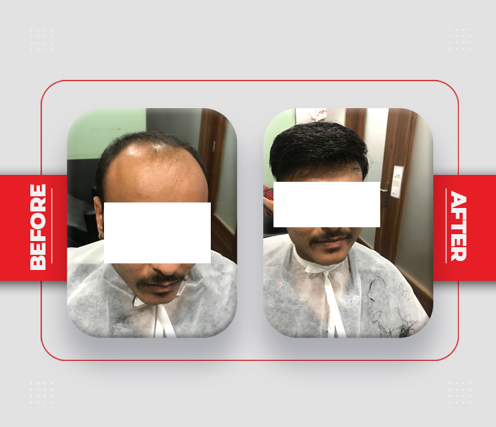 Hair Patch Service Before After