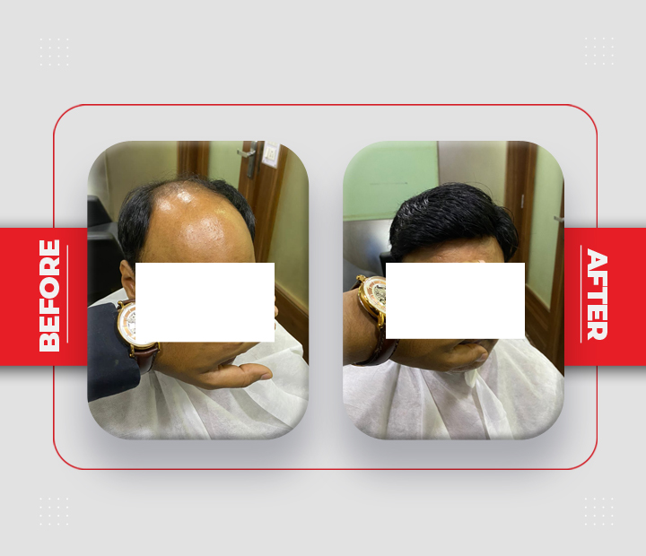 Hair Patch Service Before After