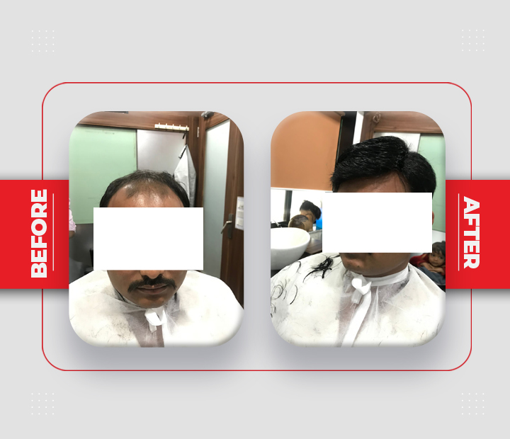 Hair Patch Service Before After