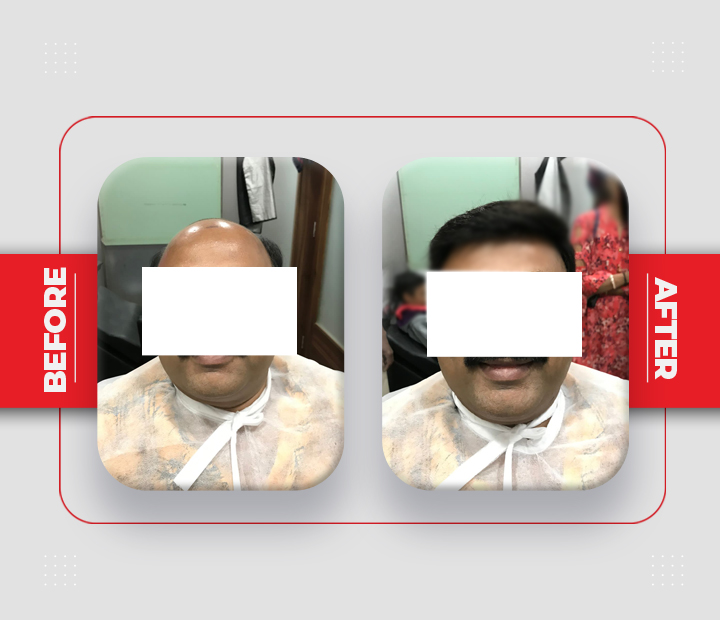 Hair Patch Service Before After