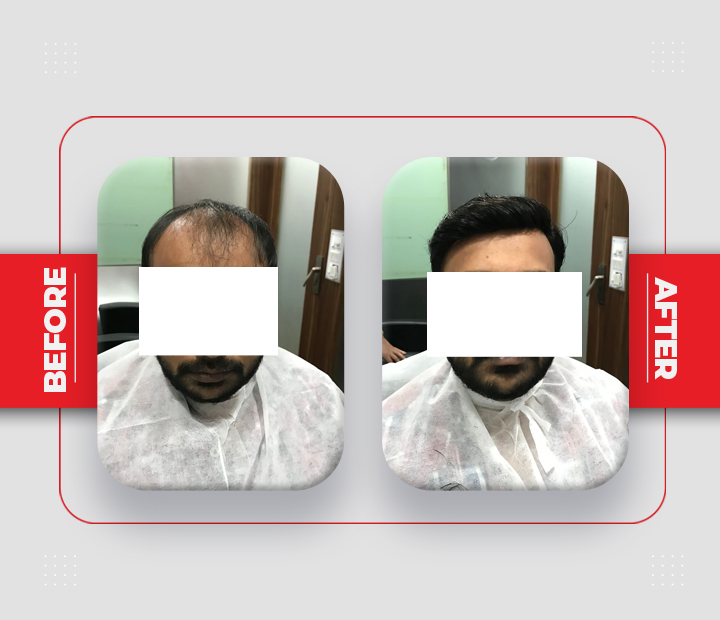 Hair Patch Service Before After